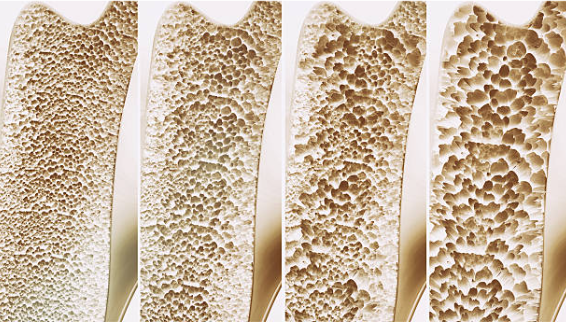 L’Osteoporosi